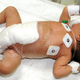 Illustration for article titled Pakistani baby born with six legs recovering well, following removal of extra limbs